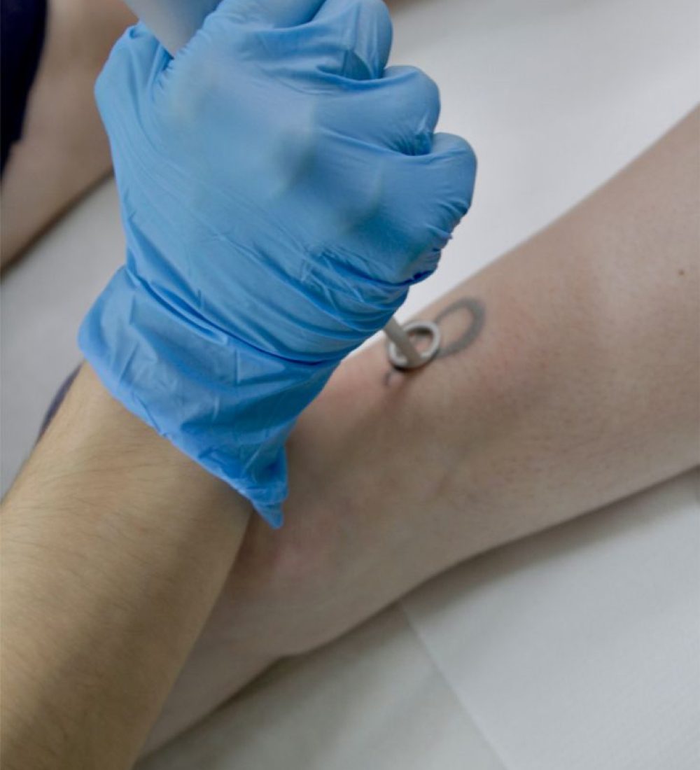 10. Remocion tatuajes